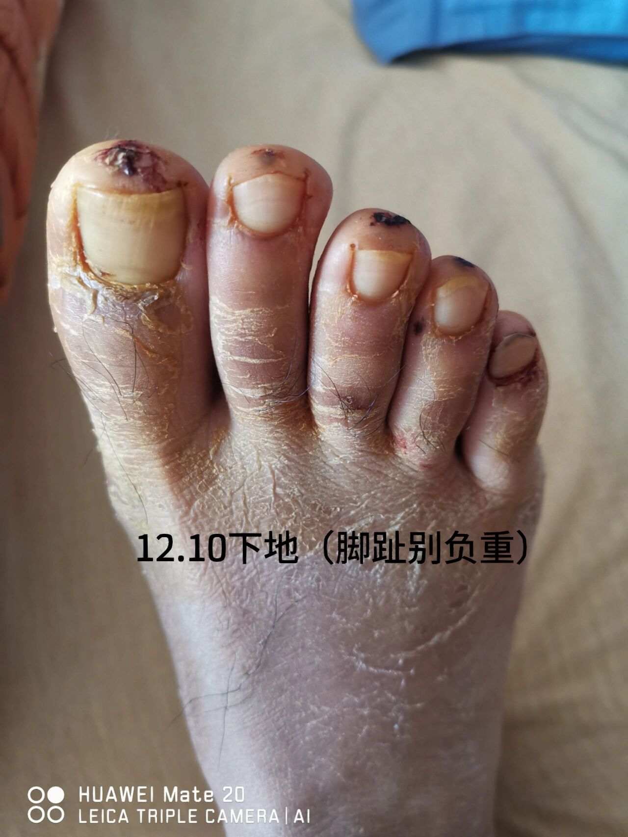博鱼体育官网-JJJ正式接受脚趾手术三个月后重新评估
